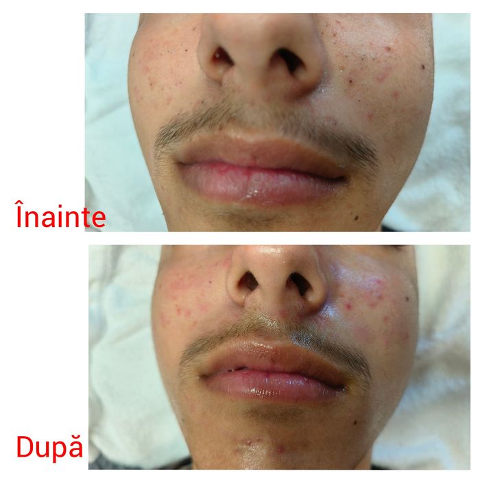 Epilare definitiva cu 4 lungimi de undă, cu ceara și tratamente