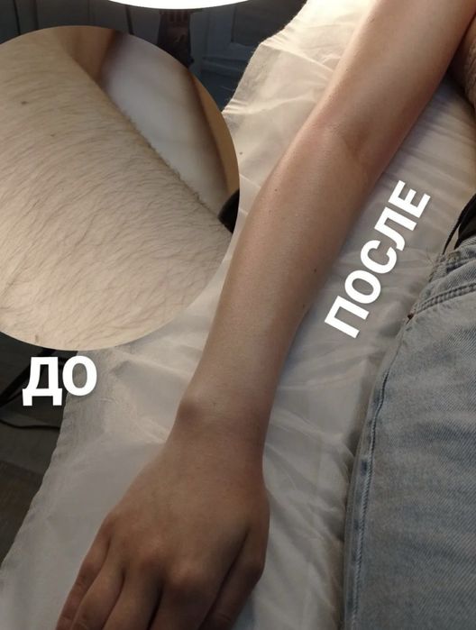 Лазерная эпиляция по выгодным ценам скидки на все зоны