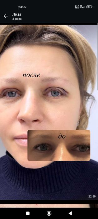 Блефаропластика.