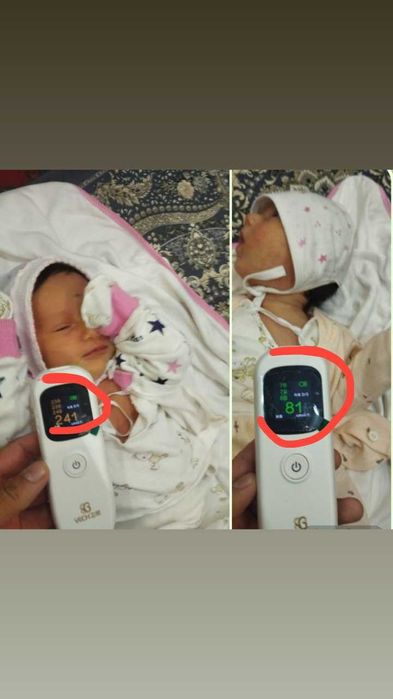 Bilitest билитест билирубиновый анализатор жетлушка фотолампа fotolamp