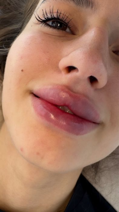 Контурная пластика губ