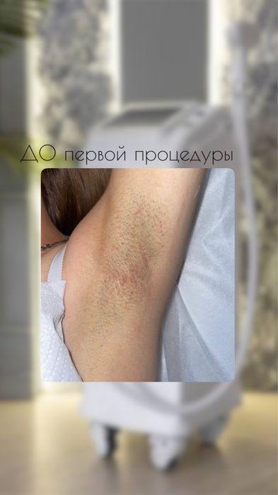 Лазерная эпиляция