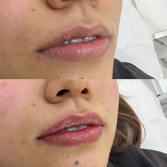 Плазмалифтинг, увеличение губ