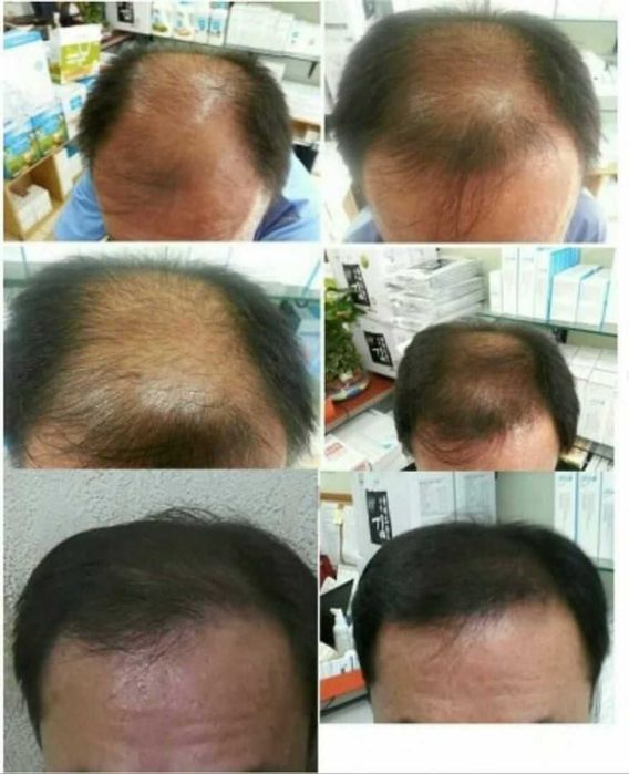 Soch tokilishiga shanpun SCALP shanpun sprey