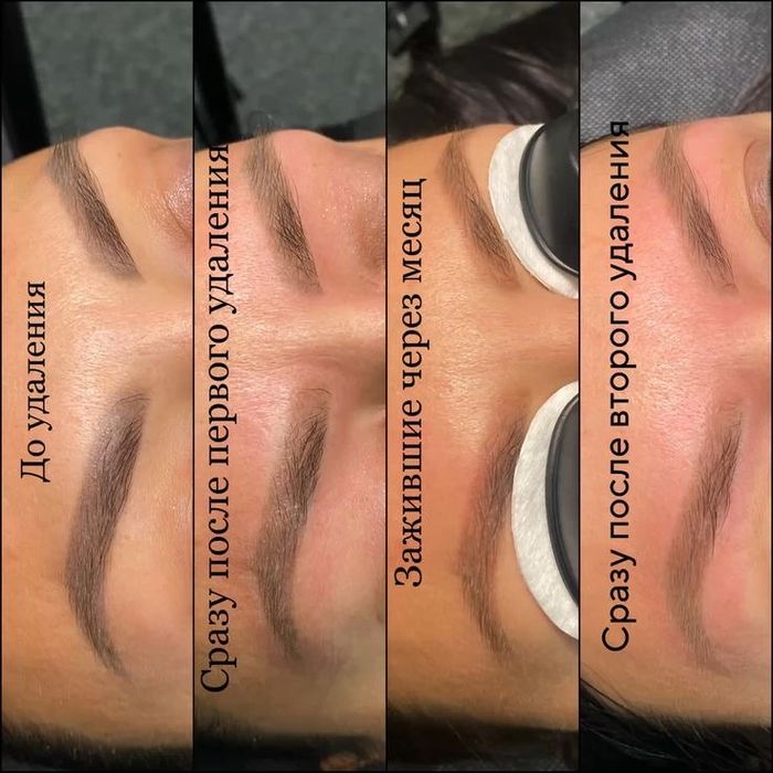 Лазерное удаление татуажа 5000