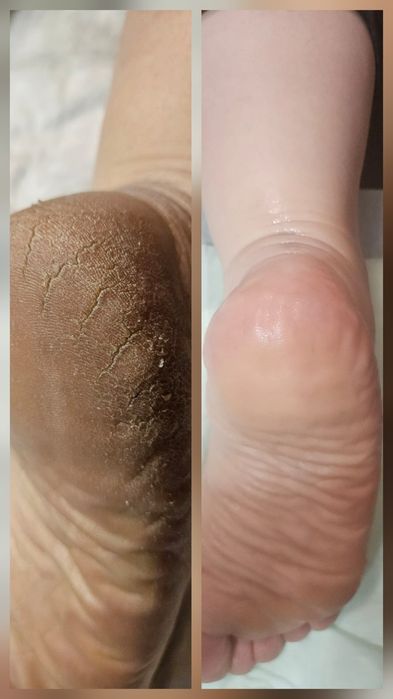 Pedichiura curativa