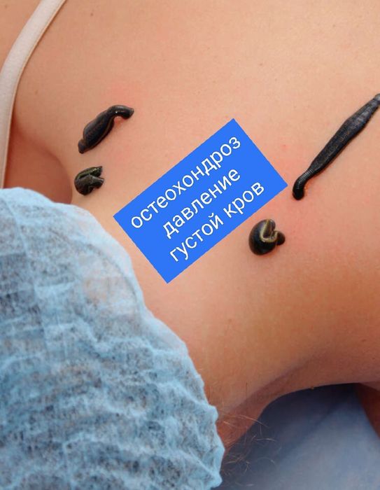 Сүлік одноразовый