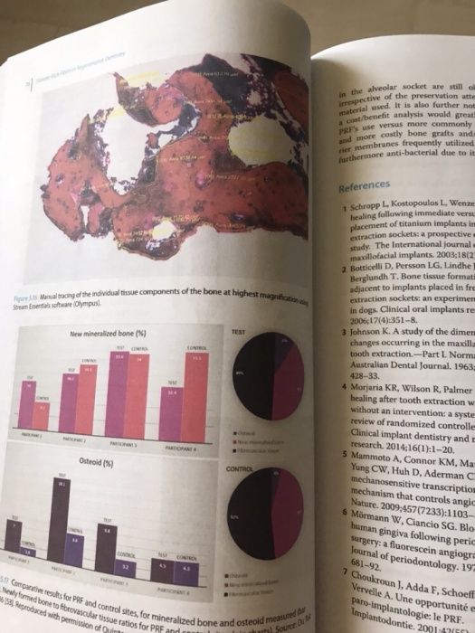Platelet Rich Fibrin in Regenerative Dentistry 2017