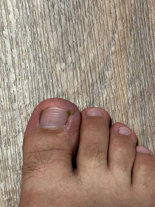 Лечение и исправление вросших ногтей.  Падолог