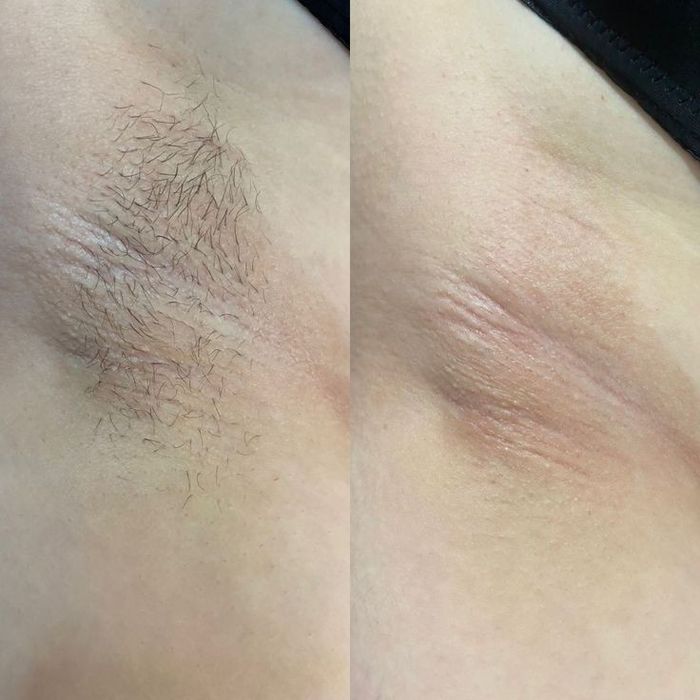 Шугаринг всего тела.