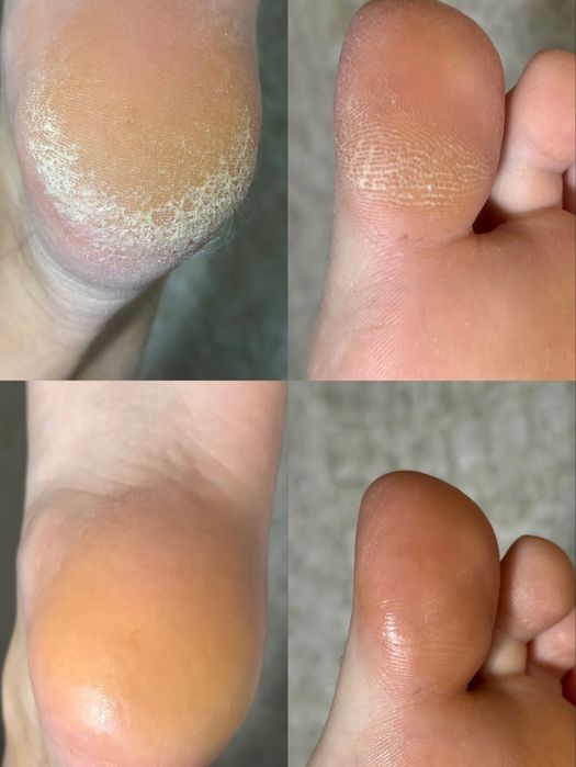 Mankiyur pidikur depilayatisya