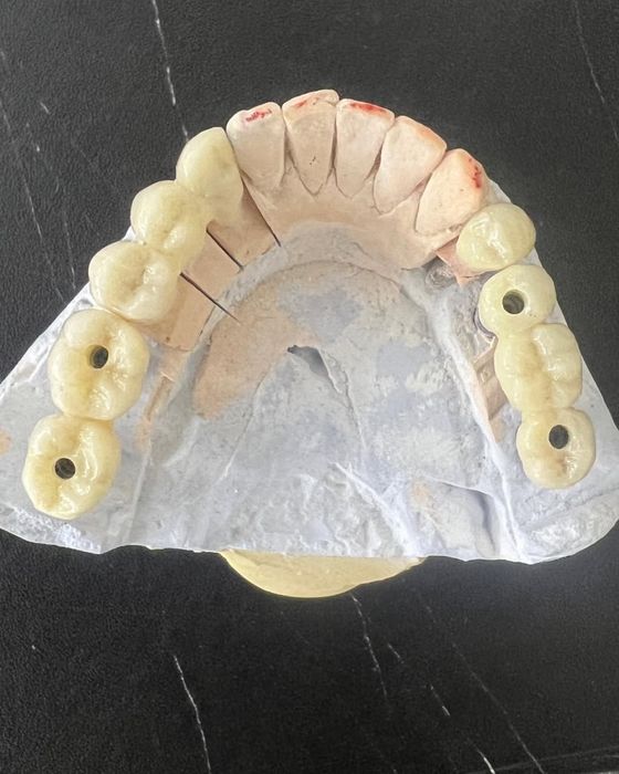 Цирконий / E-max за 2–3 дня | Luminora Dental