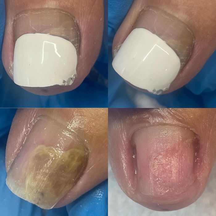 Pedichiură Medicală