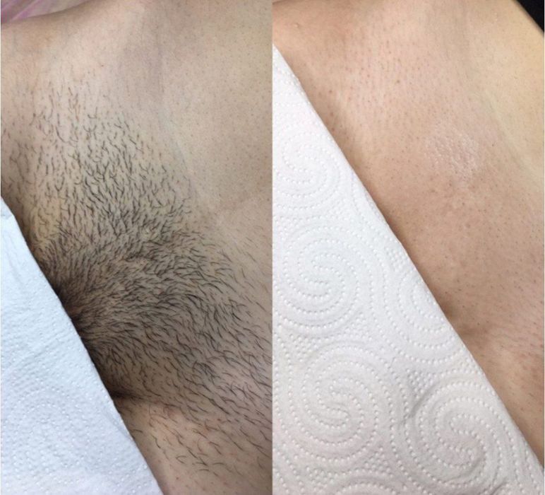 Депиляция и лазерная эпиляция для мужчин  ДОП УСЛГИ ЕСТЬ