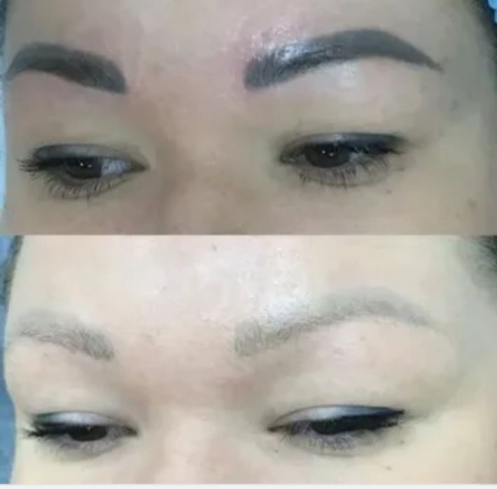 Удаление лазером тату от 5000