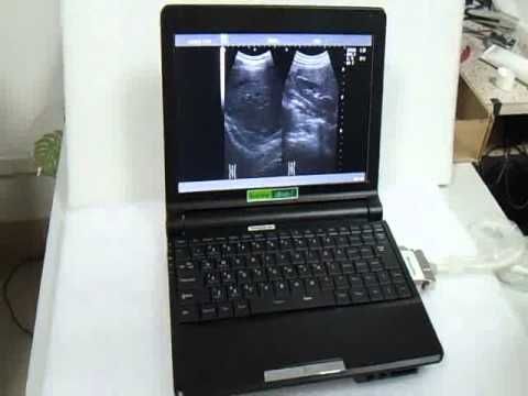 ecograf portabil laptop, cu sonda convexa si liniara, baterie 4h