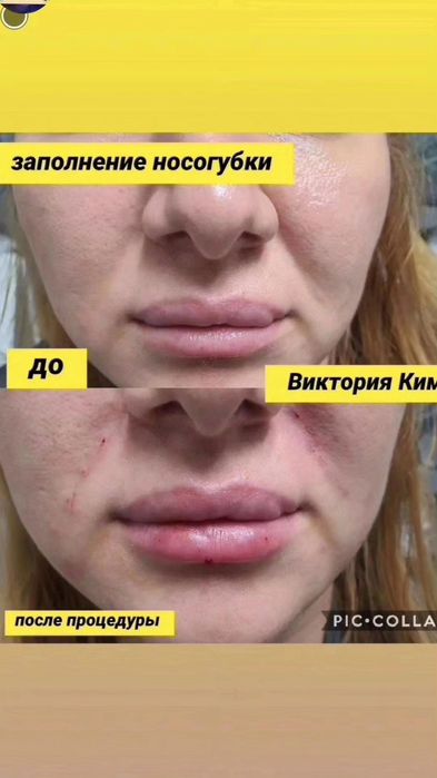 Заполнение носогубки Увеличение губ