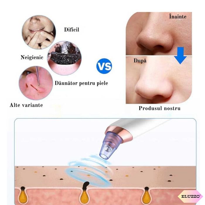 Aparat Indepartat Puncte Negre si de Grasime, NOU