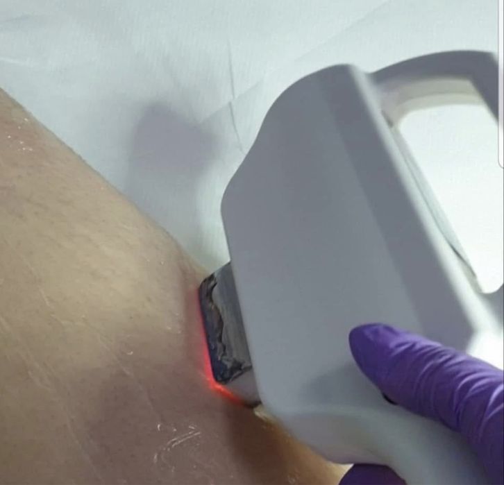 SHR si IPL  E- Light  Aparat de Epilare Definitivă