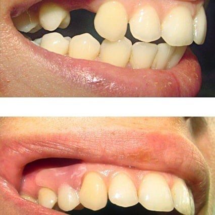 Протез зубной тех