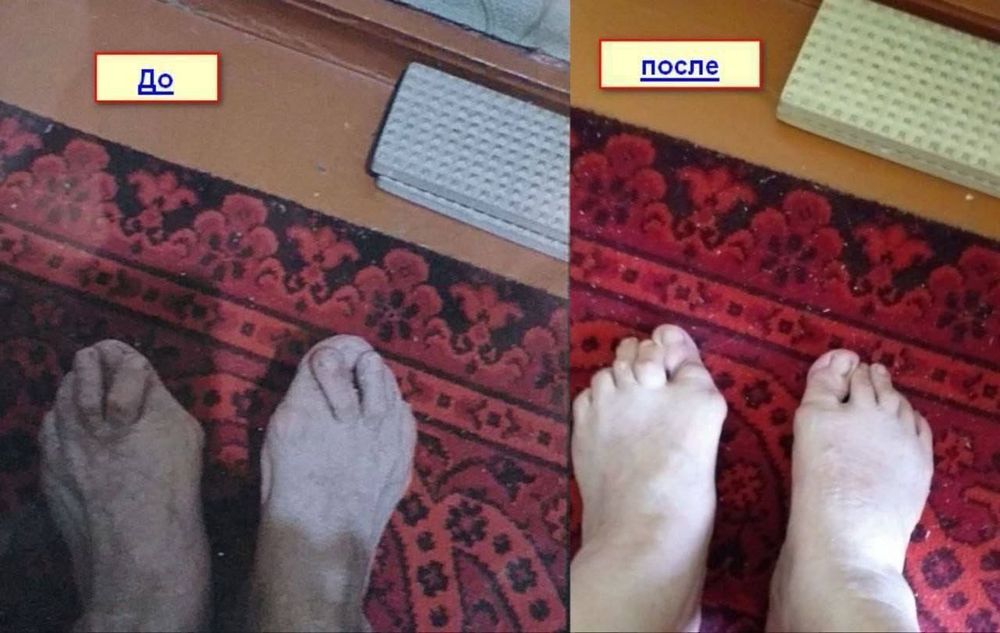 Стельки коррекционные в наличии