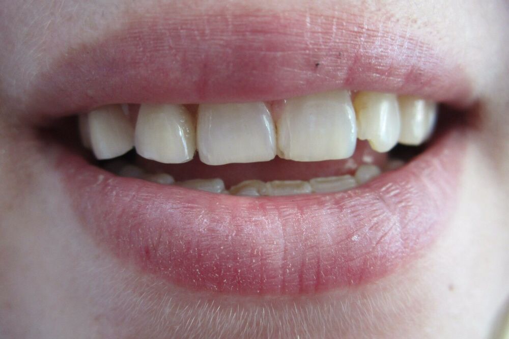 Зубные протезы    с