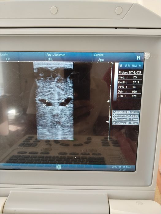 Portativ ultratovush aparati sotiladi
