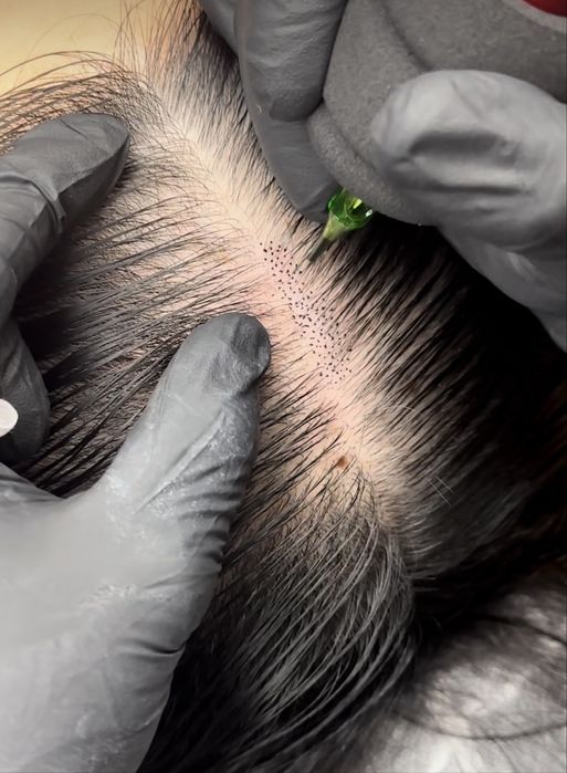 Micropigmentare scalp femei alopecie par rar camuflare indesire smp