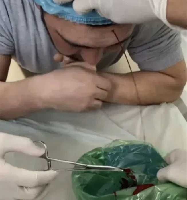 Хиджама. Шертпе. Кровопускание