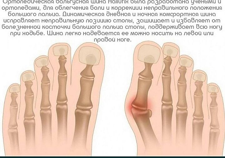 Фиксатор - корректор большого пальца ноги Hallux Valgus Plus

Доставка
