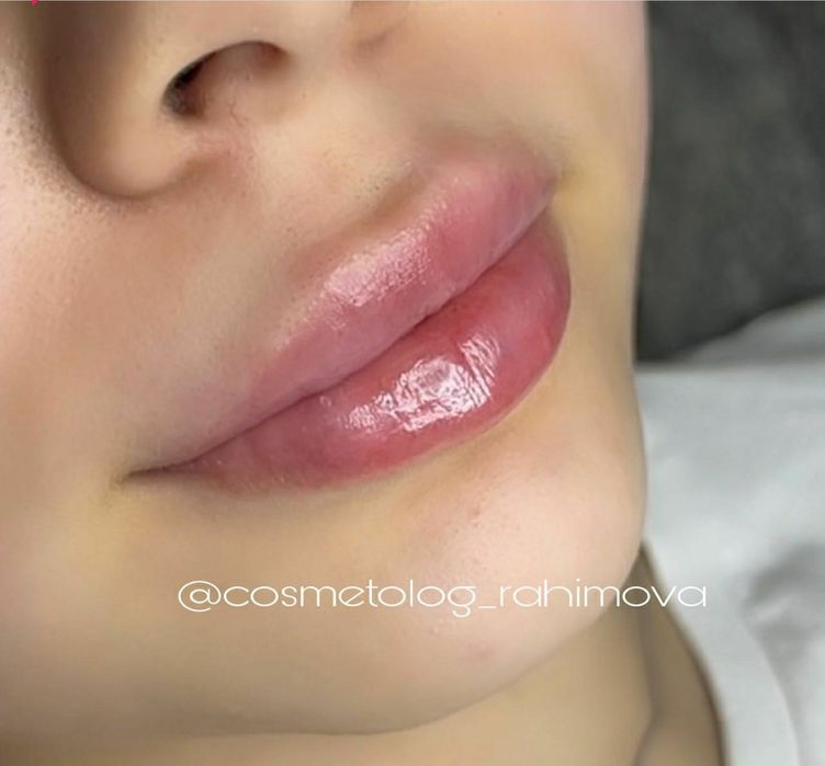 Придание обьема губам  500 тысяч  Косметология , уход, мезотерапия