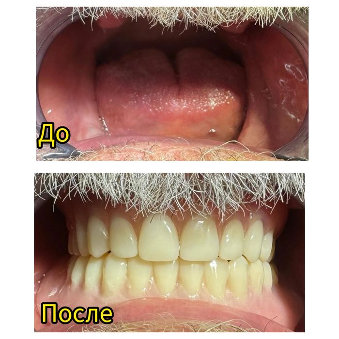 Сьемное протезирование на выезд, зубы, протез на дому