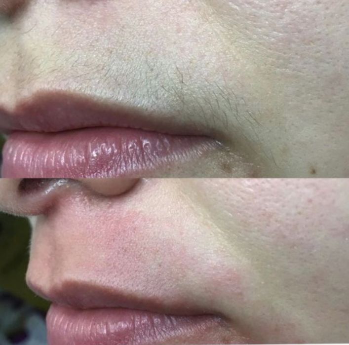 Шугаринг всего тела