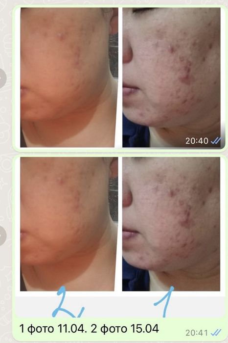 Косметика Атоми Акне