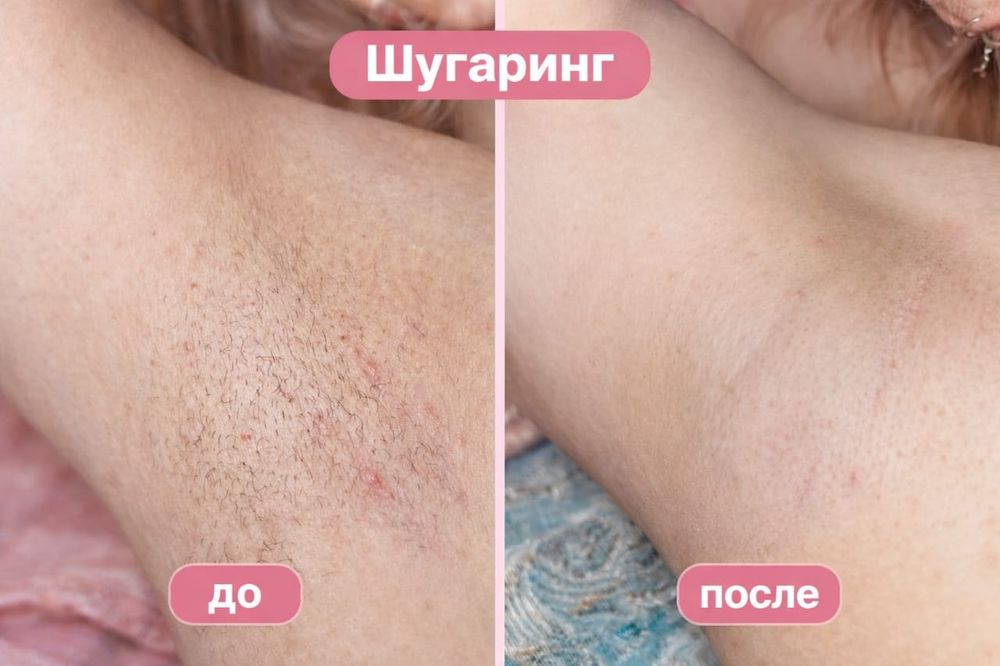 Шугаринг Темиртау