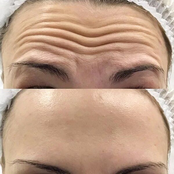 Ботокс и увелечение губ Срочно 50%скидкой места ограничены