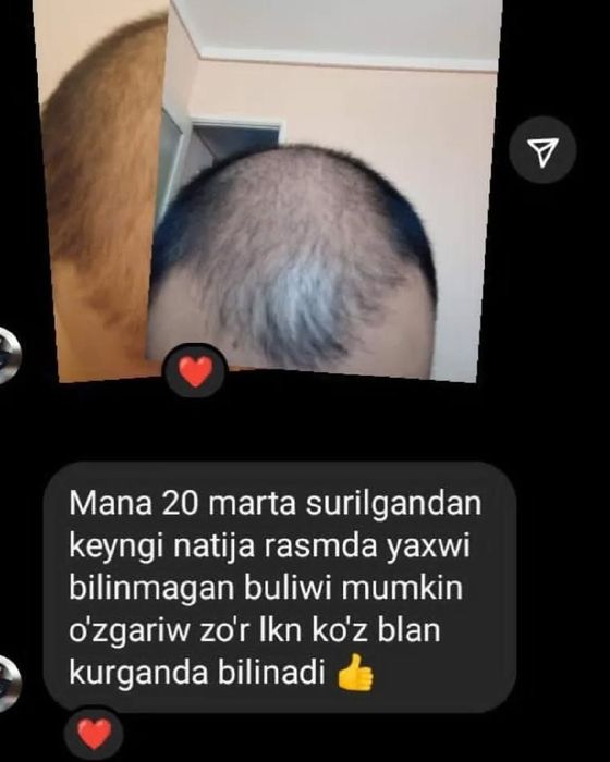 “Scalps 21+10” soch parvarishi uchun