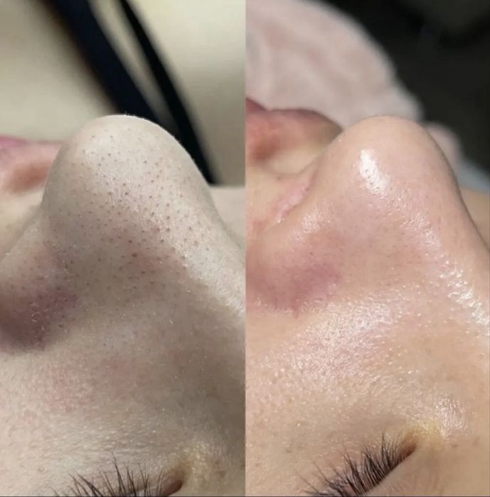 Врач Дерматолог-Косметолог |Чистка лица | Профессиональные процедуры