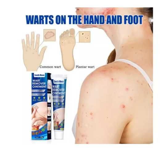 Крем за премахване на брадавици и мазоли