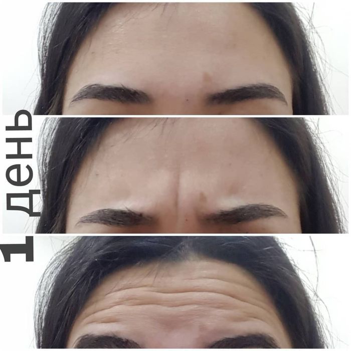 Ботокс | Косметолог Ташкент |