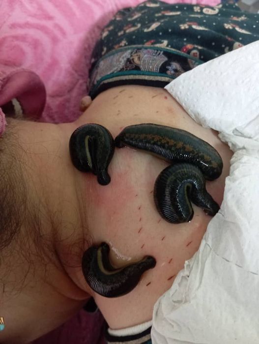 Hijoma zuluk med pratsedura