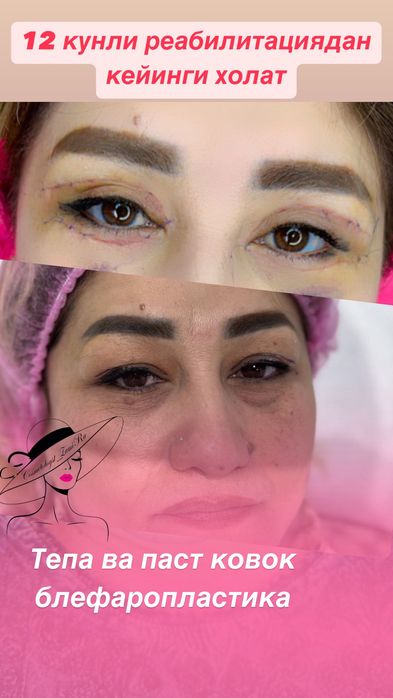 Блефаропластика Броулифтинг