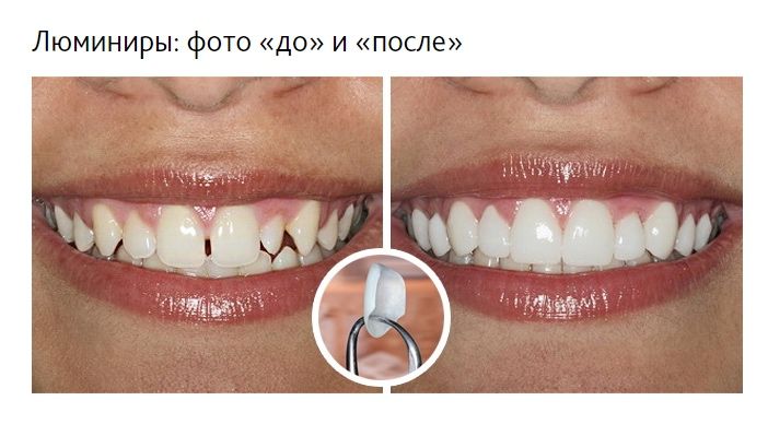 Люминиры это красиво! Стоматология