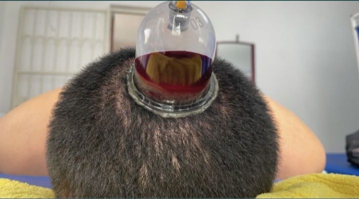 Хиджама. Кровопускание. Шертпе