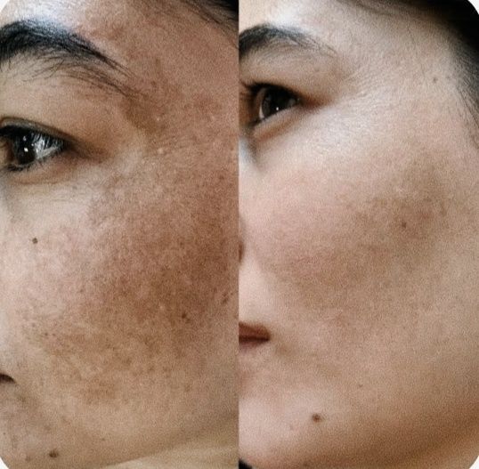 *Kosmetolog hizmatlari. Yuzdagi doglarni ketkazish