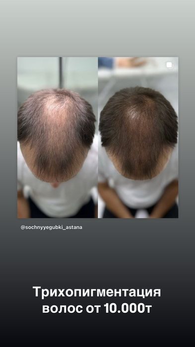 Трихопедментация головы