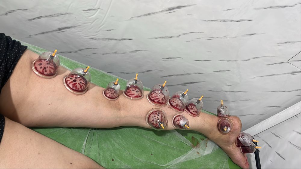 Хиджама и шертпе в городе Алматы