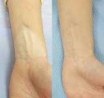 Vitiligo dog'larini kamuflyaj bilan yopish