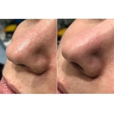 Чистка лица и шугаринг