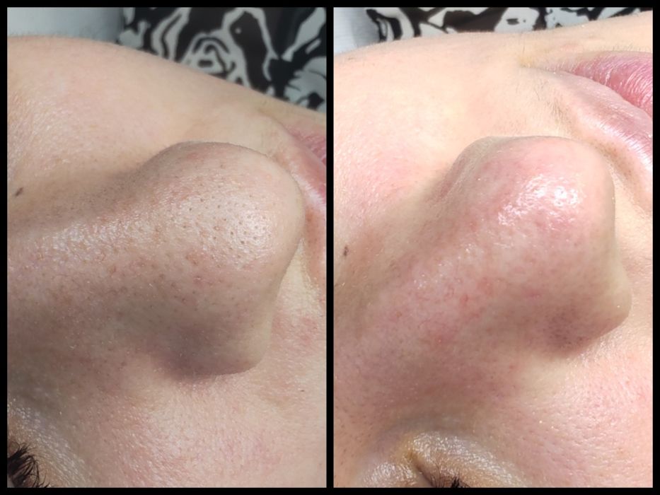 DOAR FEMEI!!! Epilat FEMEI cu ceara de unica folosința,Ep. Definitiva